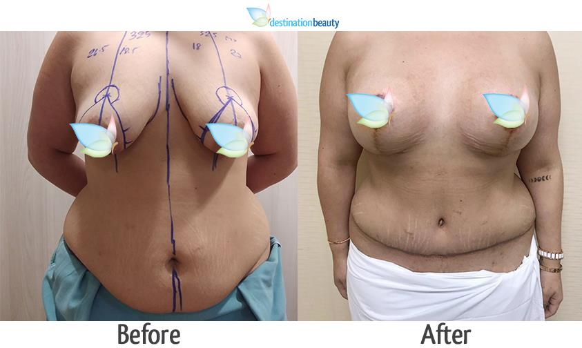 Breast augmentation with lift and tummy tuck in Thailand See